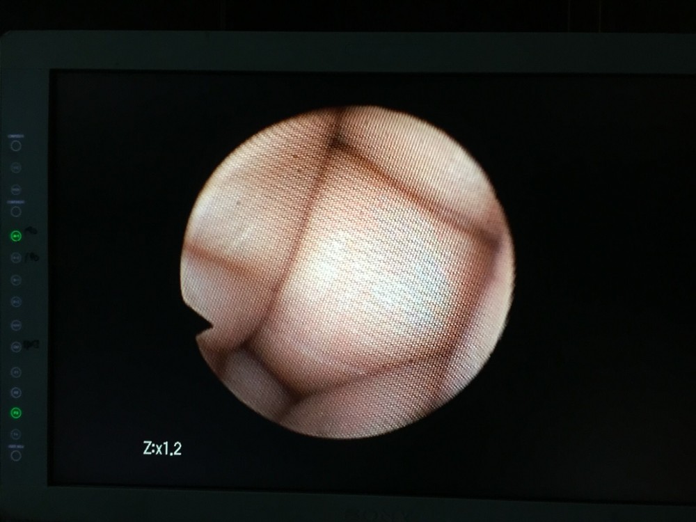 Pentax FB-18X Bronchoscope Endoscope Endoscopy (1191-s5)_