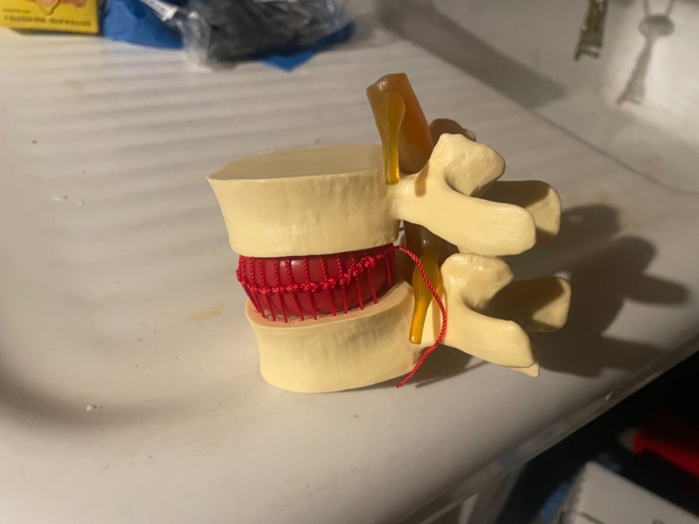 MEDICAL ODDITY DISPLAY: Vintage Herniated Lumbar Disc Spine Model - WoW!!!