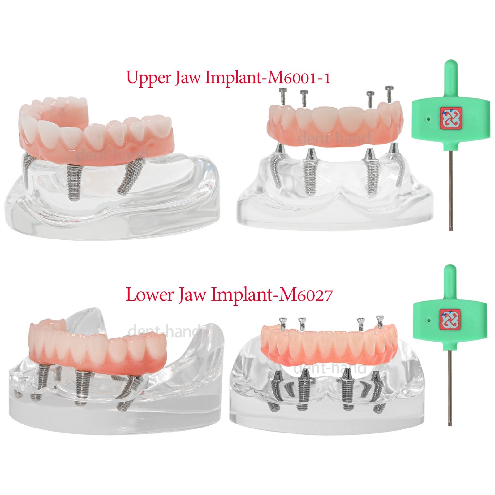 Dental Upper/Lower 4 Implants Demo Implant Teeth Model Restoration Overdenture
