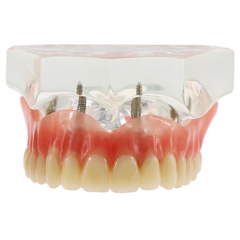 Dental Typodont Implant Overdenture Teeth Model 4 Implants Upper Lower