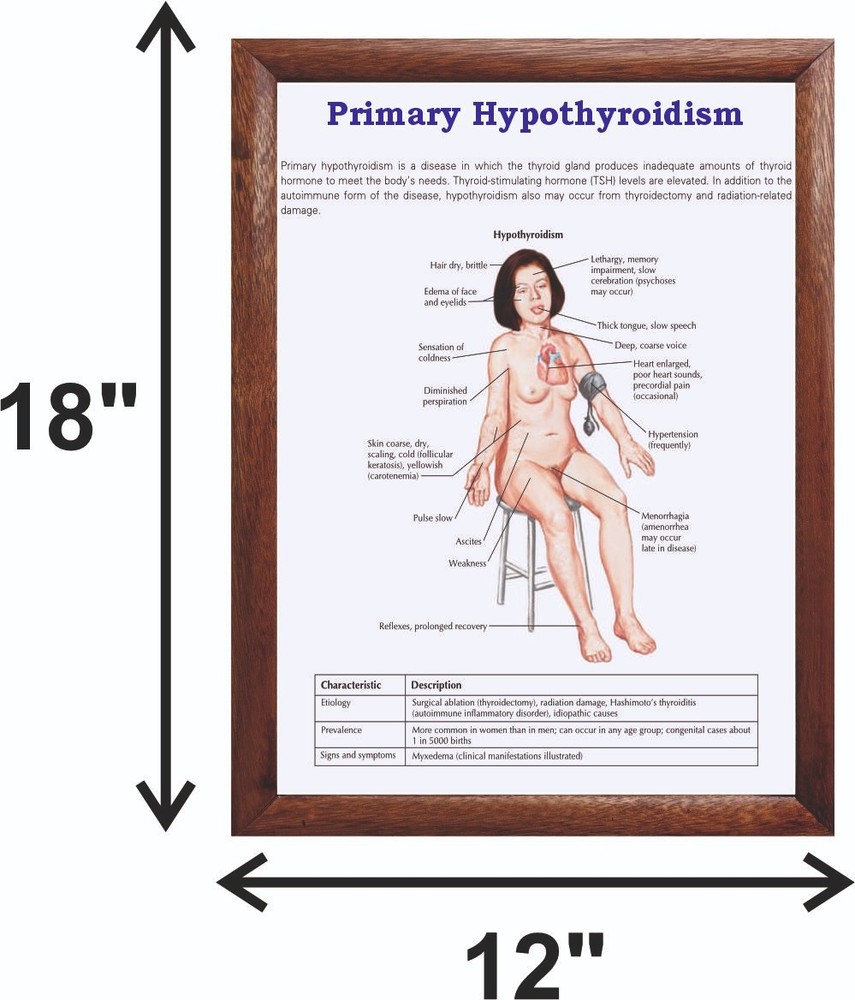 Primary Hypothyroidism Chart 12x18 inches