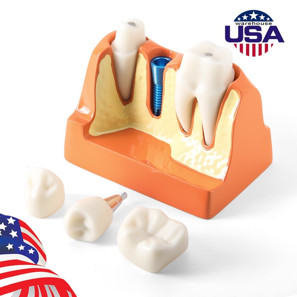 4 Times Dental Teeth Model Implant Crown Bridge Removable Study Teaching Tool