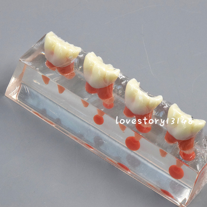 1 Set Dental Teeth Model #4018 01 - 4-Stage Endodontic Treatment Study Model