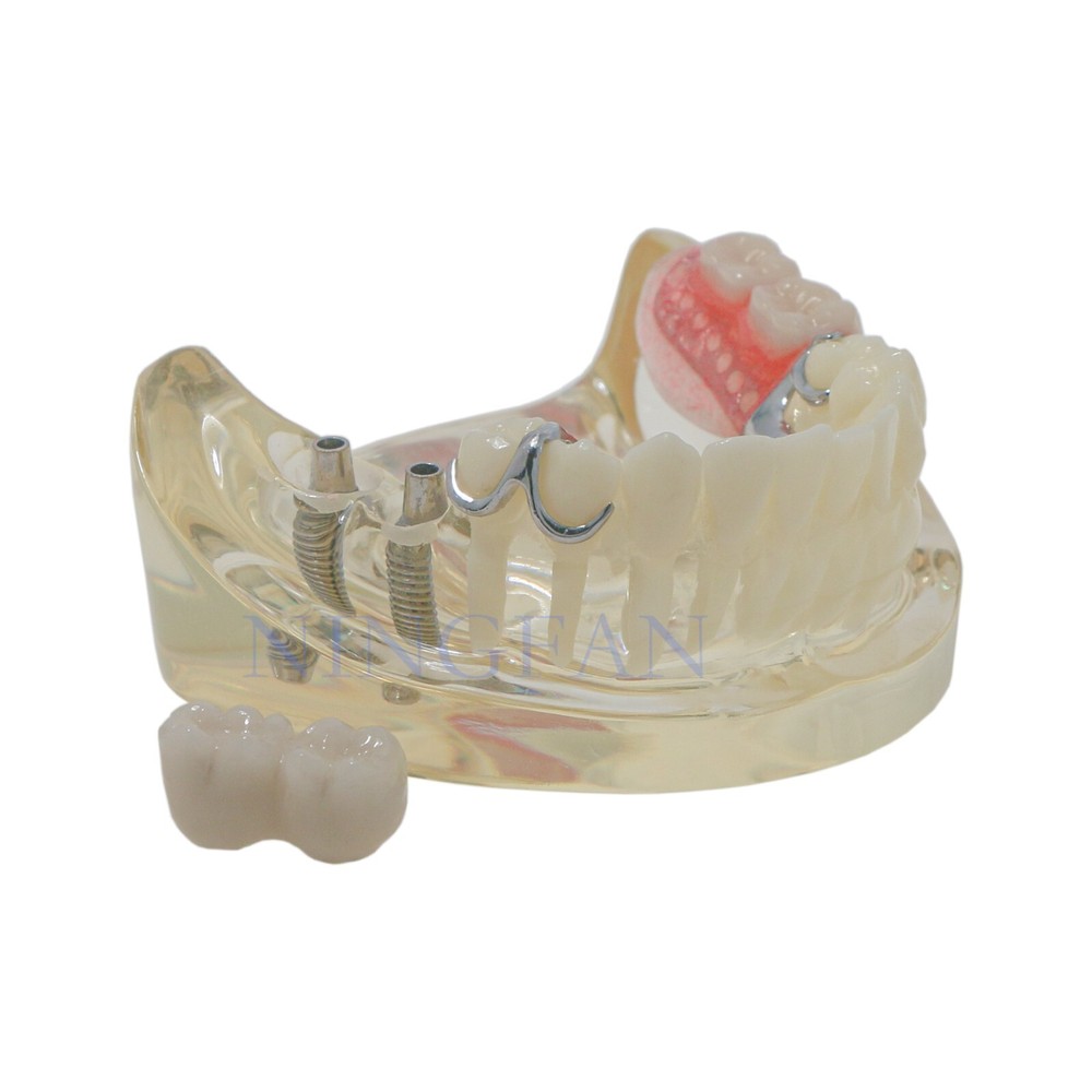 Dental Typodont partial denture Model RPD Demo Retainer WIth 2 Implants