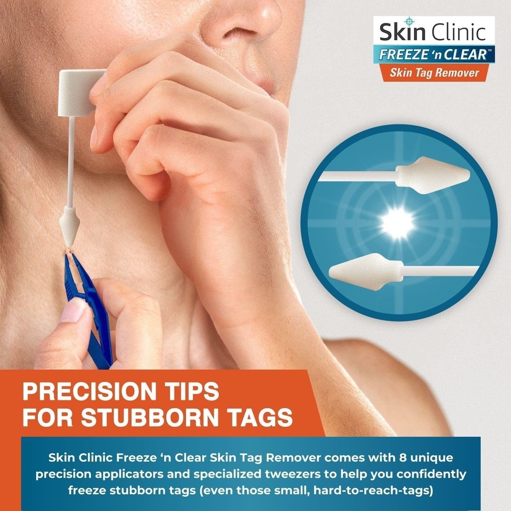 Effortless Skin Tag Treatment Kit - 8 Precision Tips, -Cleared Solution