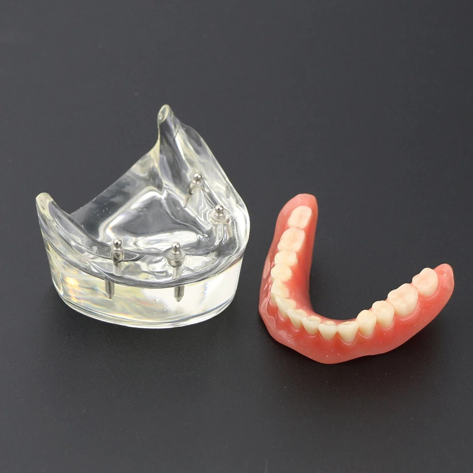 Dental 2/4 Implants Upper Lower Teeth Model Lower Demo Overdenture Restoration