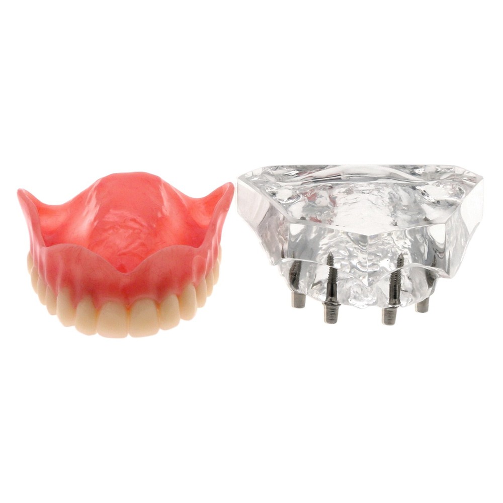 Detal Typondont Restoration Implant Overdenture Teeth Model 2 4 Implants