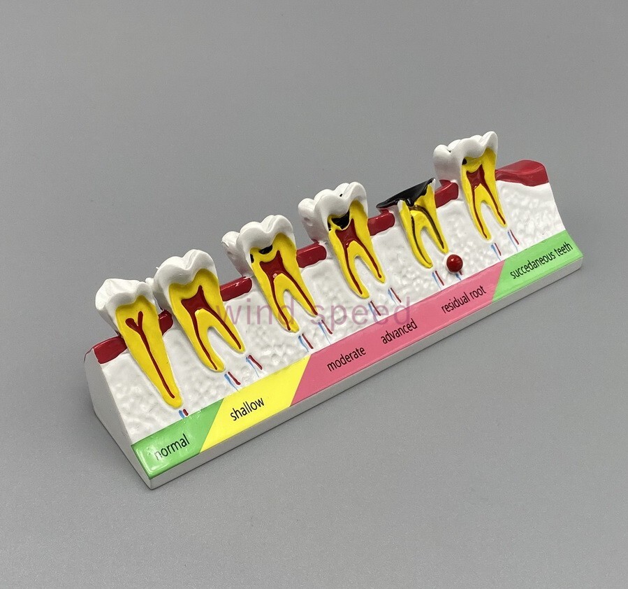 Dental lab Study Teaching Models Caries Disease Assort Teeth Dentoform Model