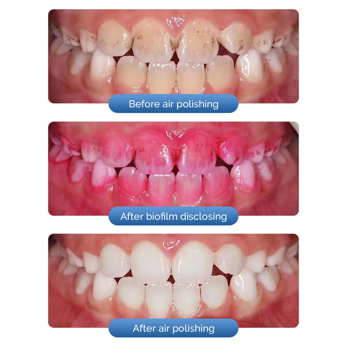 Dental Air Flow Teeth Tooth Polisher Handpiece Hygiene Prophy Jet 2/4 Hole Blue