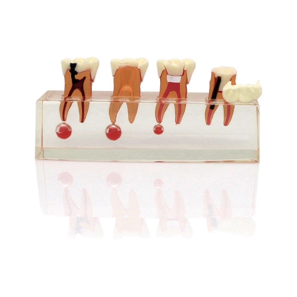 1Pc Endodontic Dental Root Canal 4 Stage Study Teaching Demonstrates Model #4018