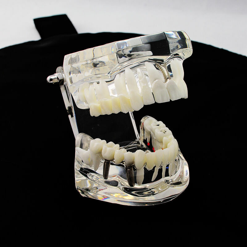 Dental Transparent Pathological Teeth Study Model Implant and Restoration Model