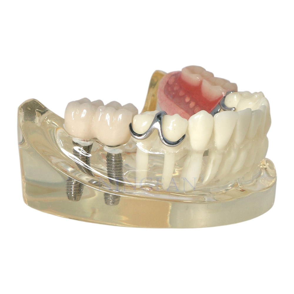 Dental Typodont partial denture Model RPD Demo Retainer WIth 2 Implants
