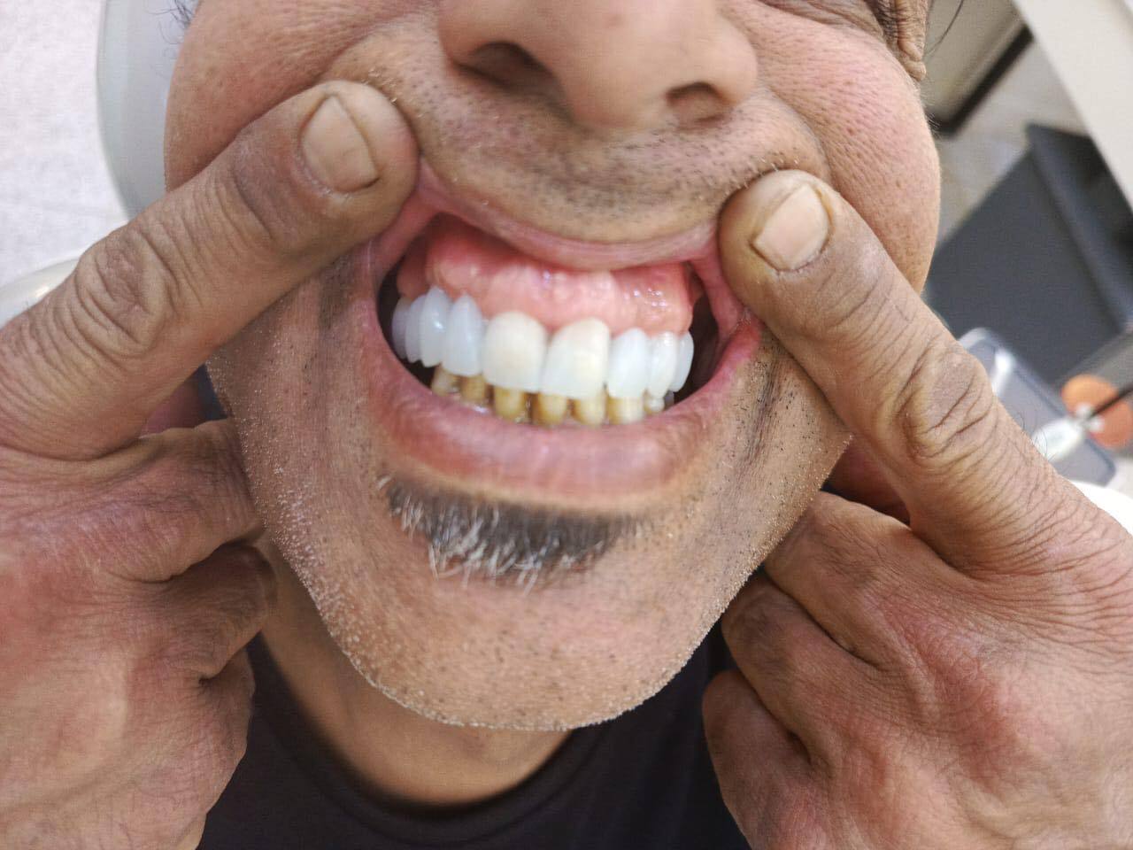 DLP SLA LCD 3d printer ALL ON X resin - for all on x cases, bridges,arcs, hybrid