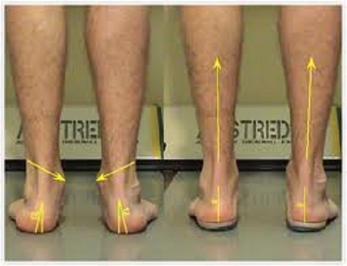 2 Pair Custom Fit Orthotics Insole for Pain Relief - Feet, Ankle, Knee, Back