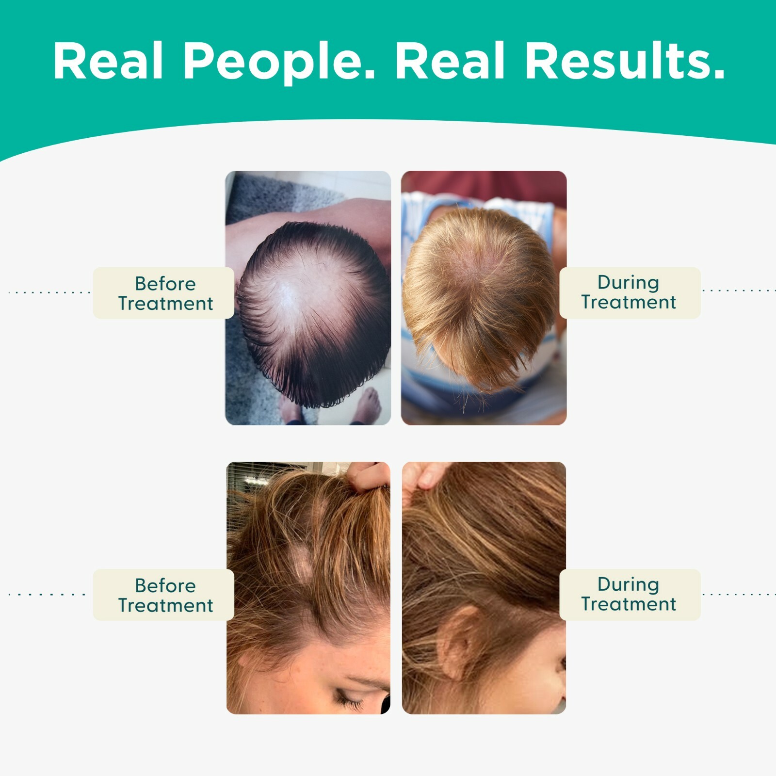 Shapiro MD Patented Hair Loss Kit for Thicker, Fuller, Healthier Hair