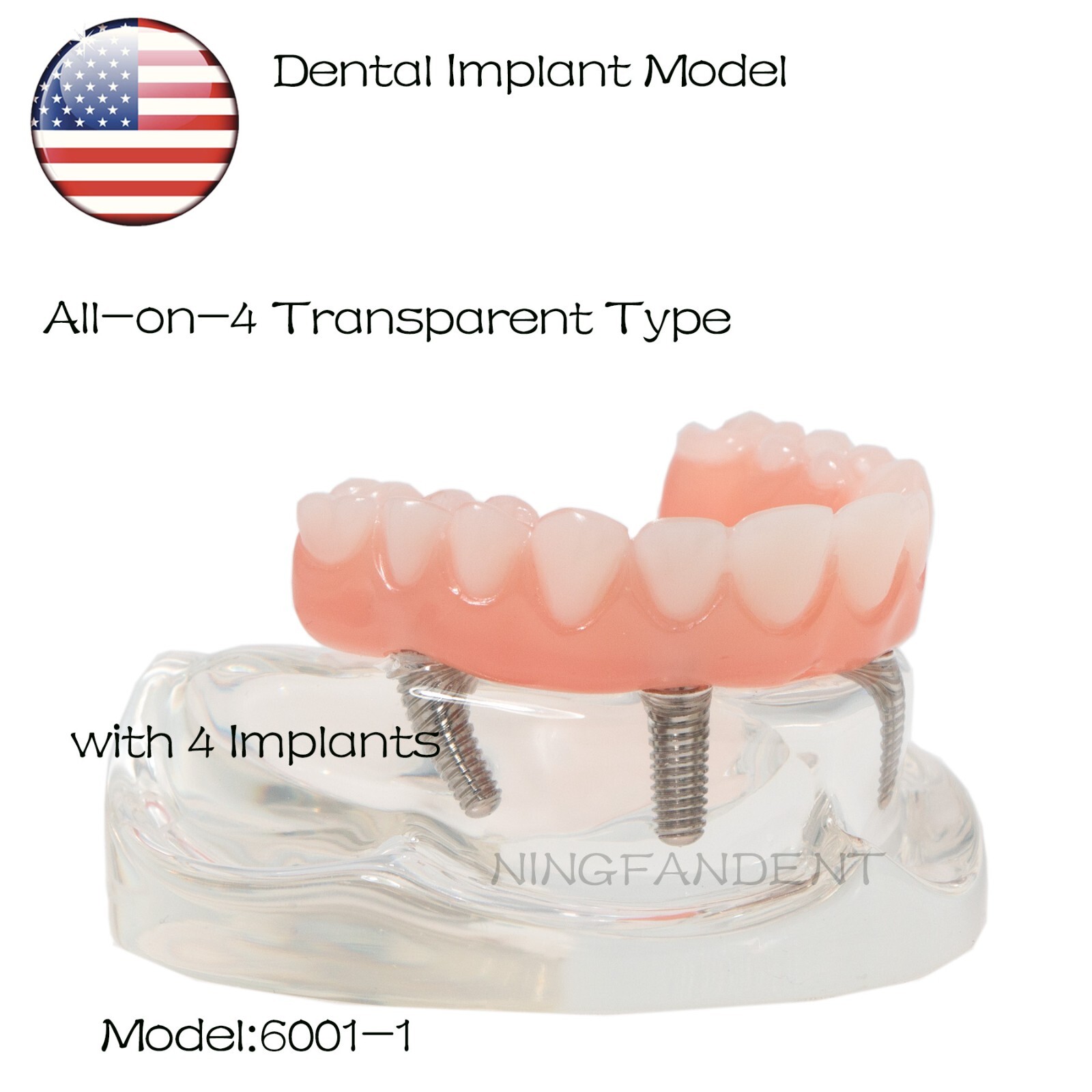 US Dental All-on-4 Overdenture treatment Implant Model Upper 4 Implants Clear