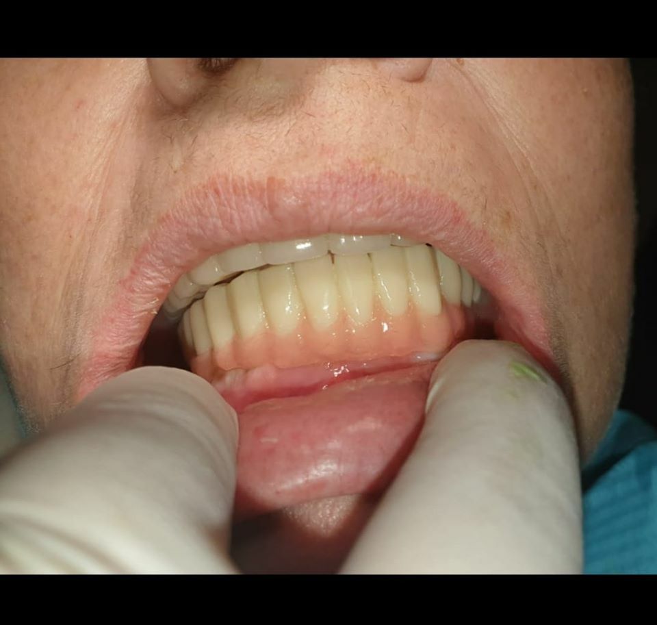 DLP SLA LCD 3d printer temporary teeth resin ..