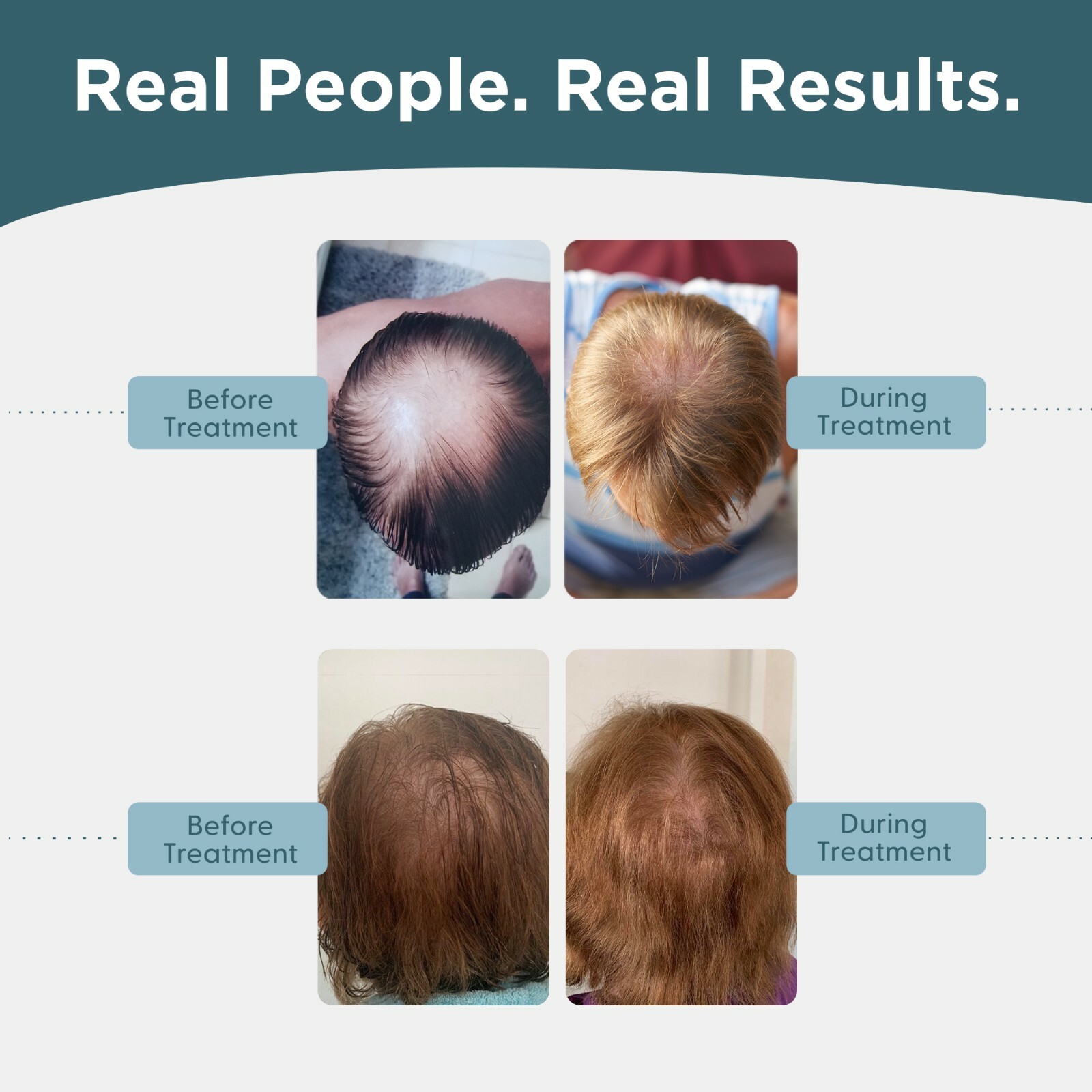 Minoxidil 5% Topical Solution for Men Hair Regrowth, Reactivates Hair Follicles