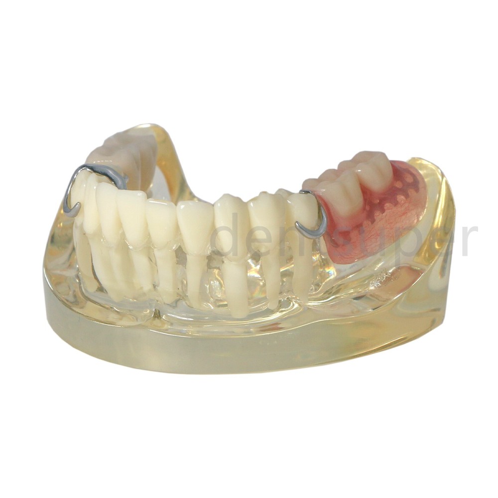 Typodont Restoration Dental Teeth Model With Partial Denture Demo 2 Implants