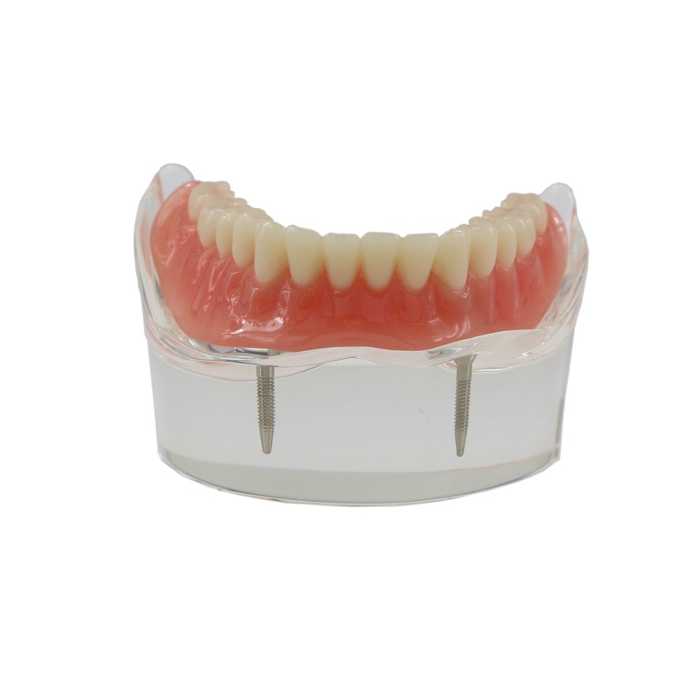 Implant Restoration Teeth Model Mandibular Overdenture with 2 Implants Dental