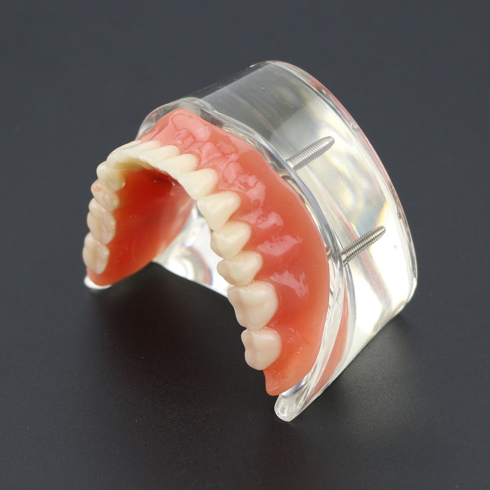 Dental Typodont Lower Teeth Demo Study Model Overdenture Inferior 4 Implants