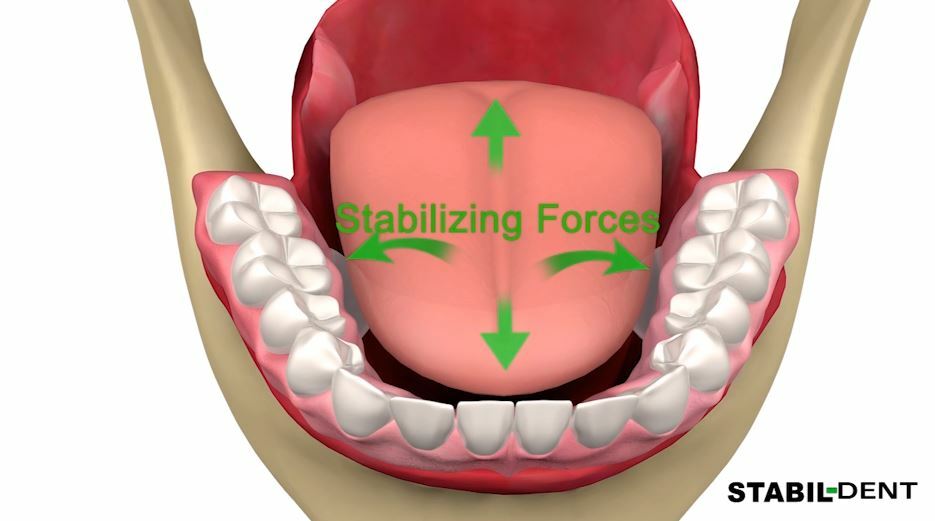 Lower Denture Stabilizers DIY Kit-Affordable Denture Stabilization