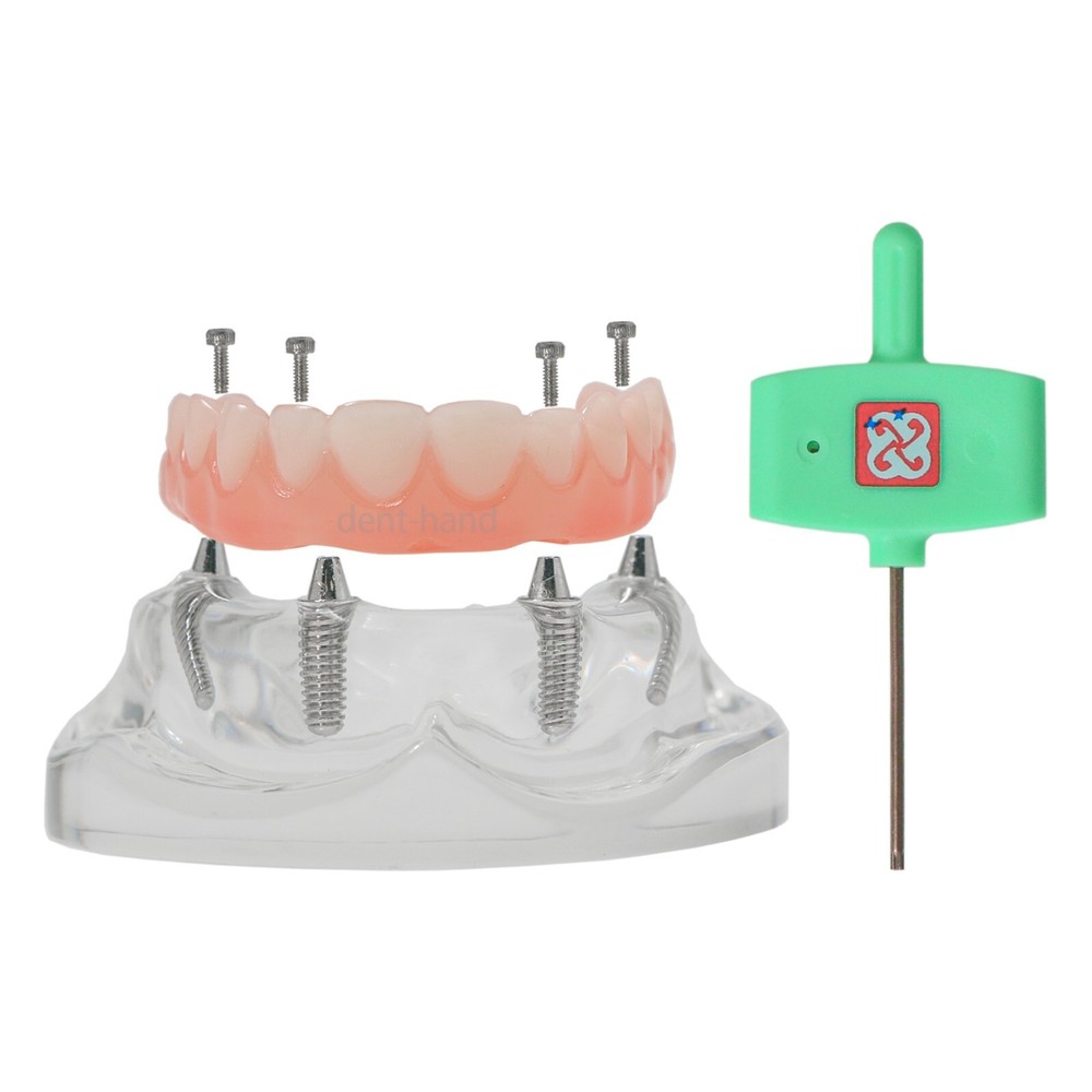 US Dental Overdenture Upper/Lower 4 Implants Demo Teeth Restoration Model