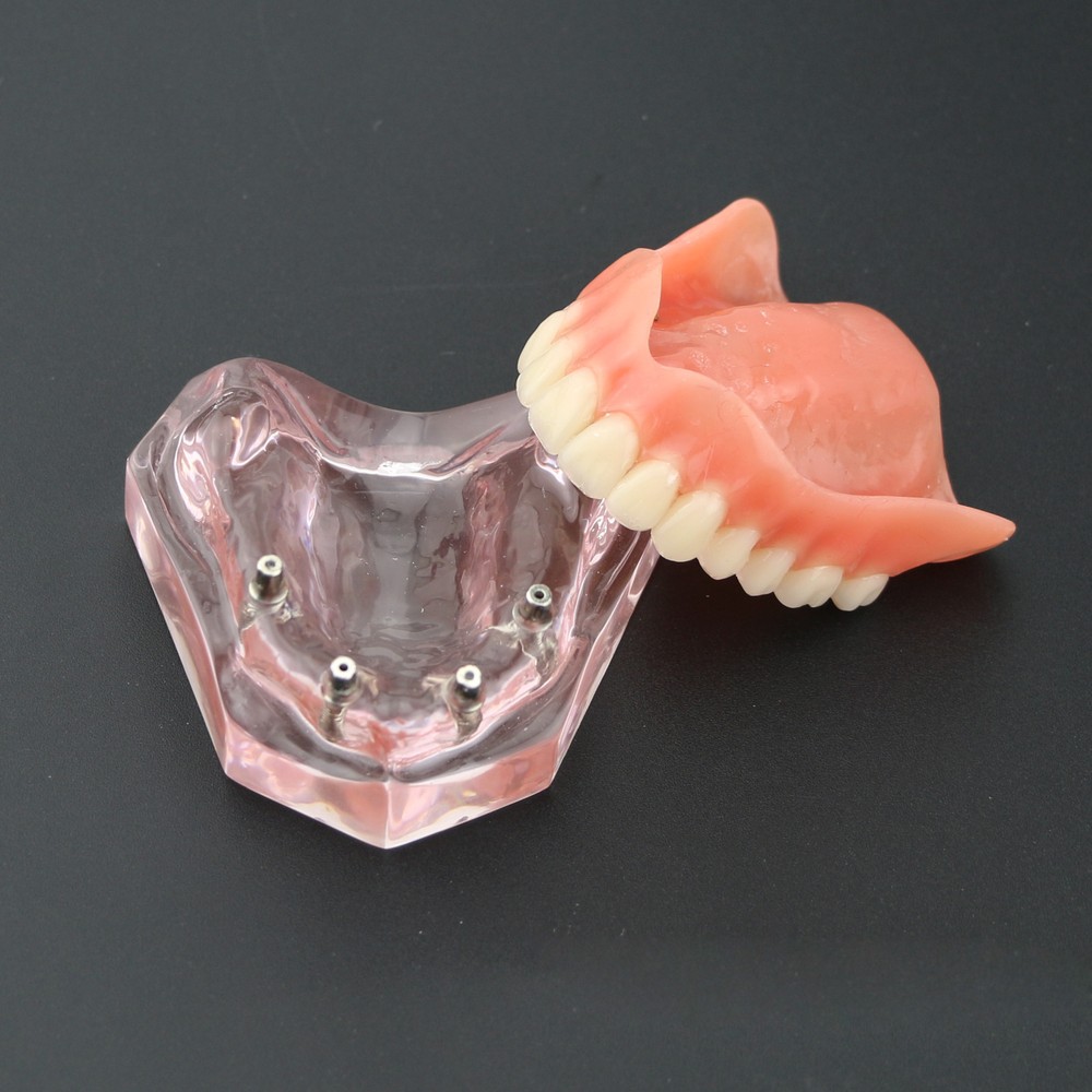 Dental Typodont Teeth Model Superior 4 Implants Overdenture Superior Demo Model