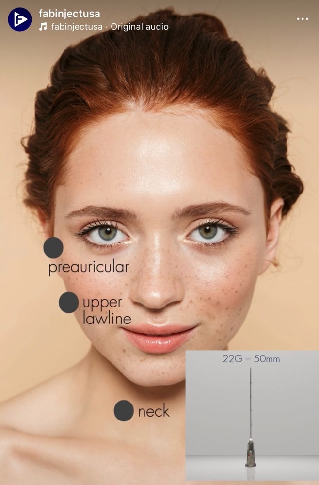 Microcannula Slim 22G - 50MM - 1box with 10 unit