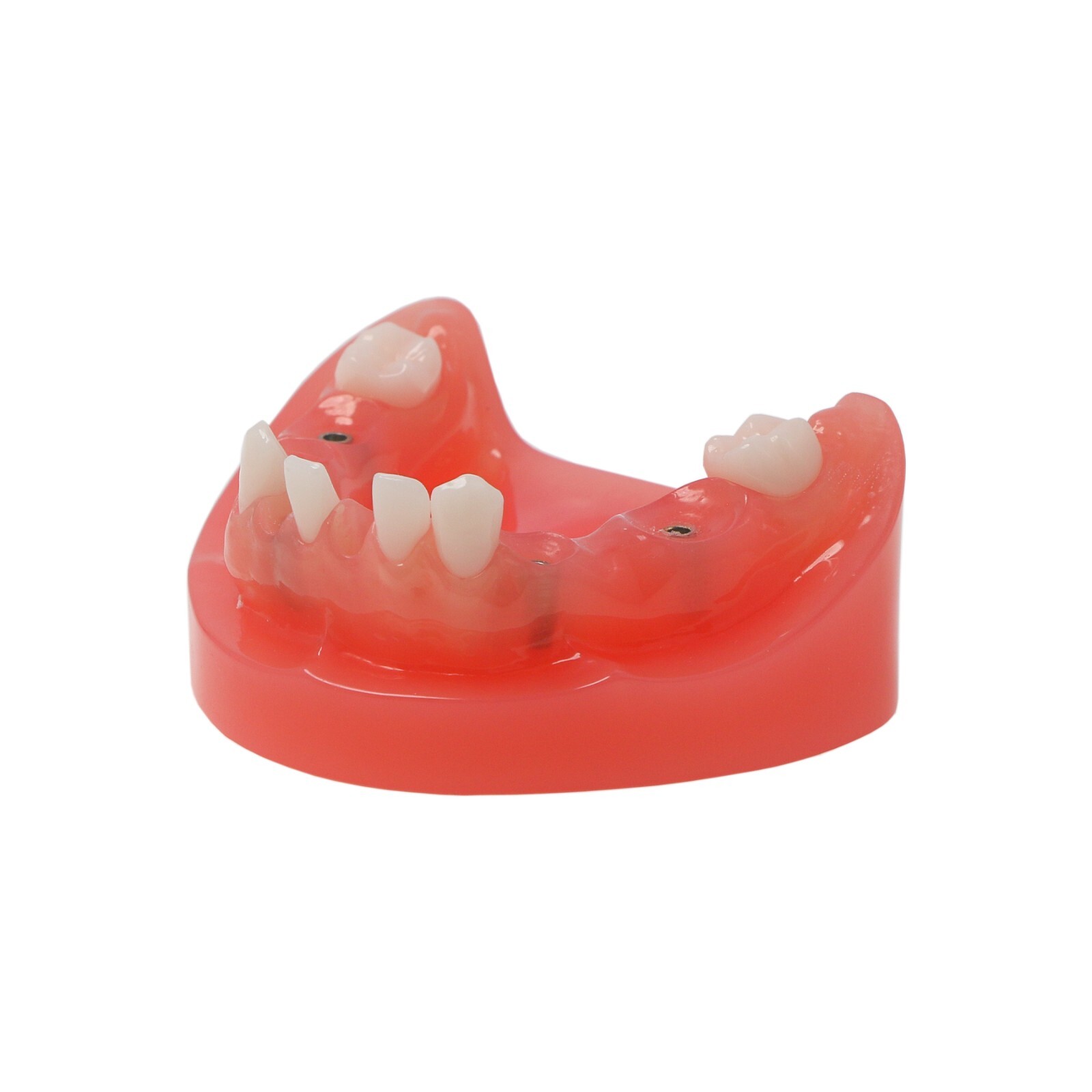 Dental Implant Typodont Teeth Restoration Model Series Overdenture Practice Demo