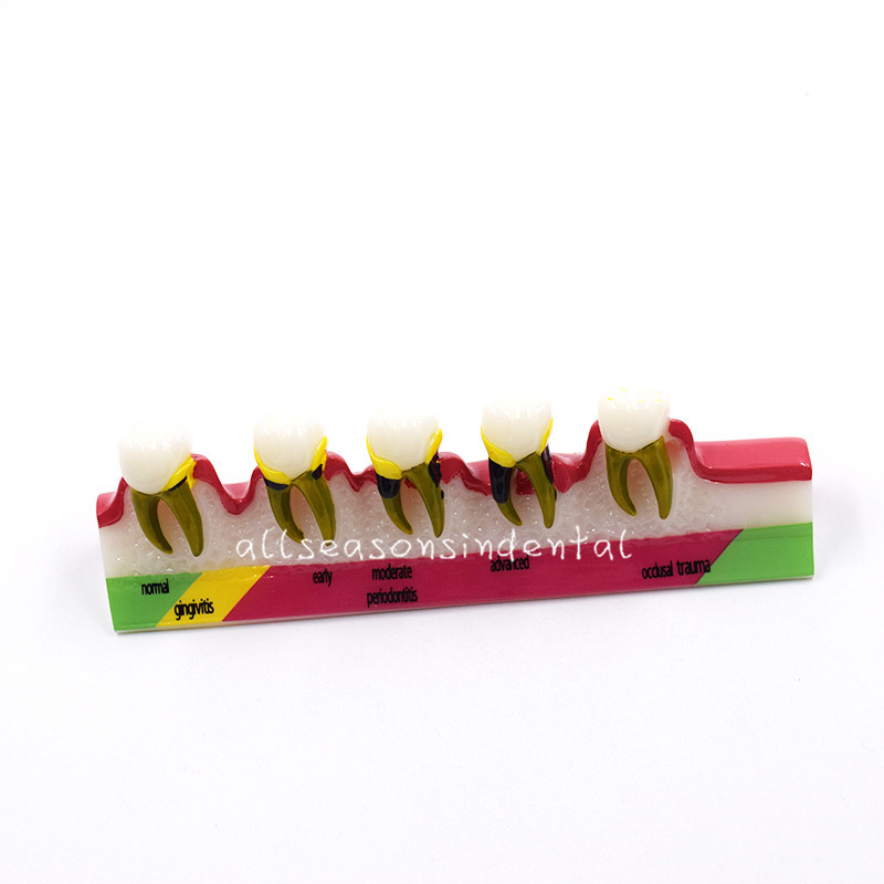 Dental Study Teaching Model Periodontal Disease Assort Teeth Dentoform Typodont