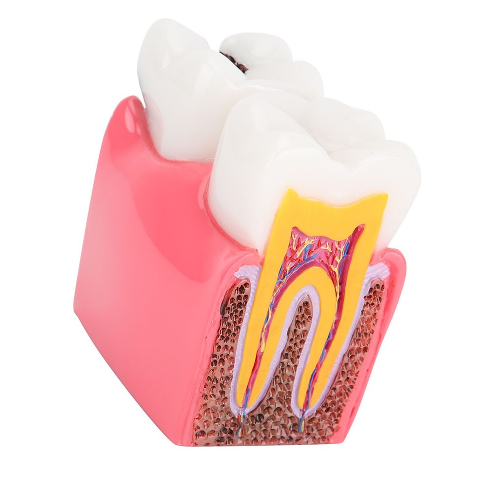 Caries Comparison Study Models Dentist Dental Anatomy Education Teeth Model