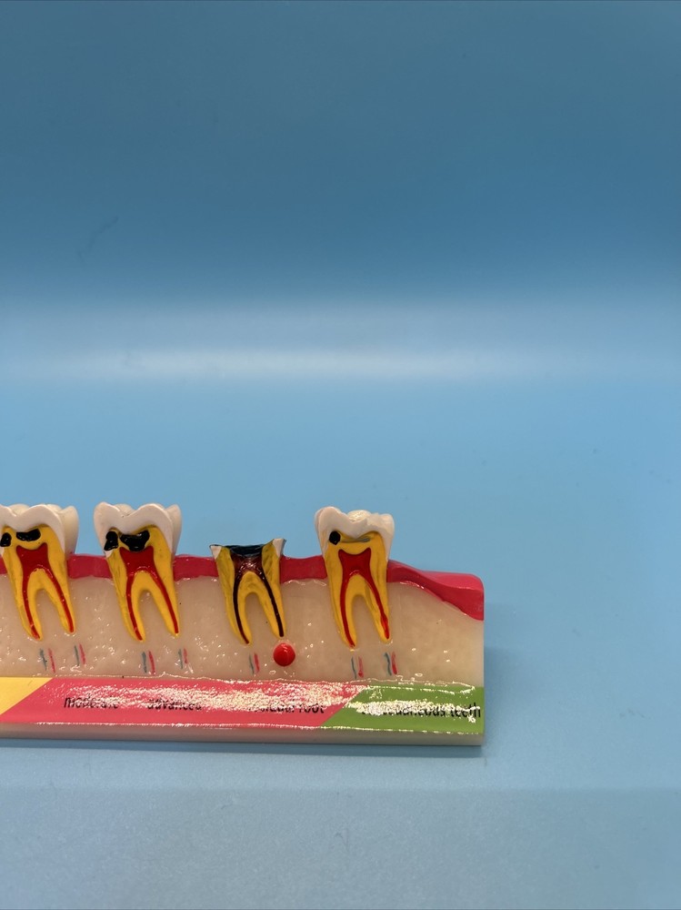 Dental Caries Developing illusteation teeth disease Tooth Model Demonstration