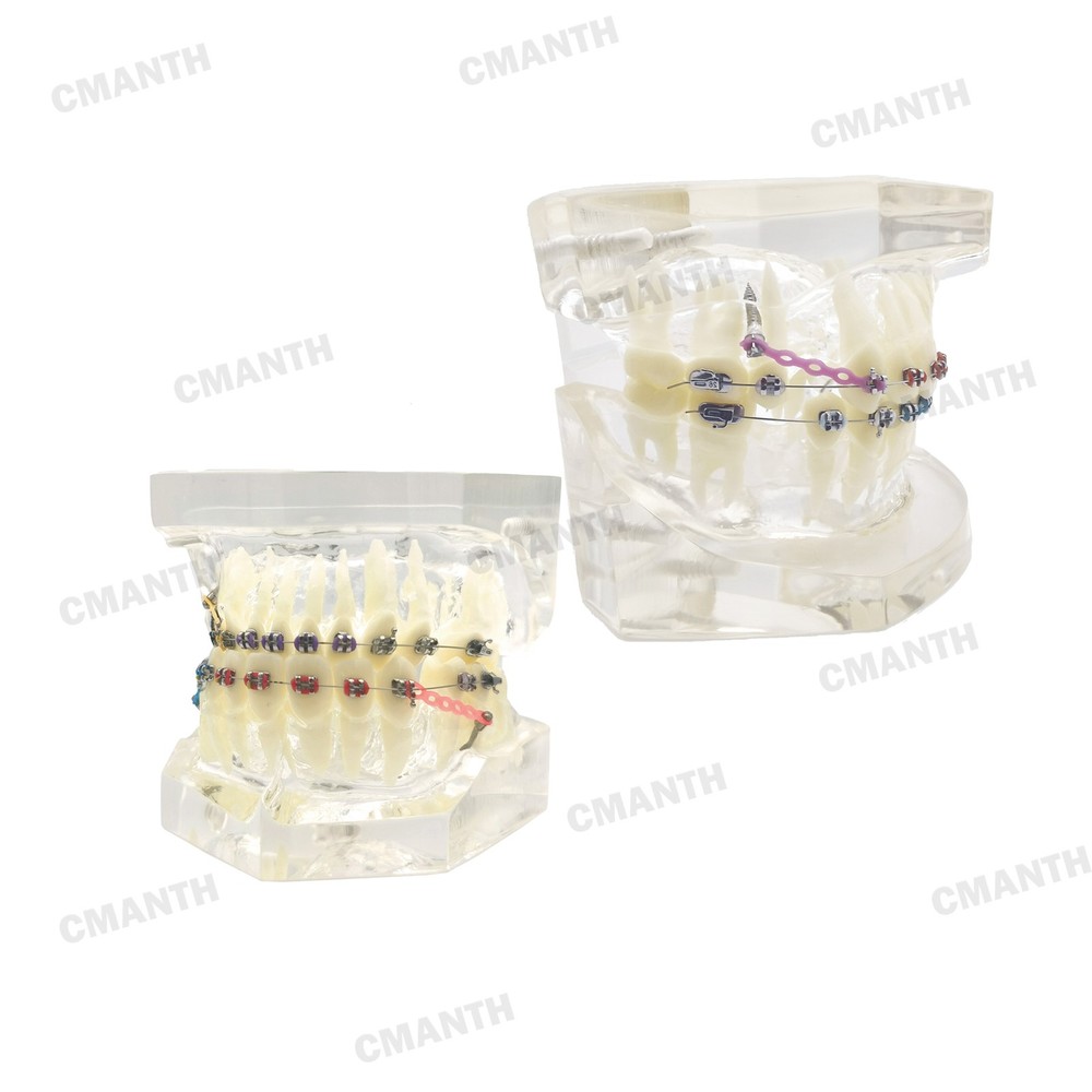 Dental Teeth Model Ceramic Brackets Orthodontic Correction Teaching Model M3005