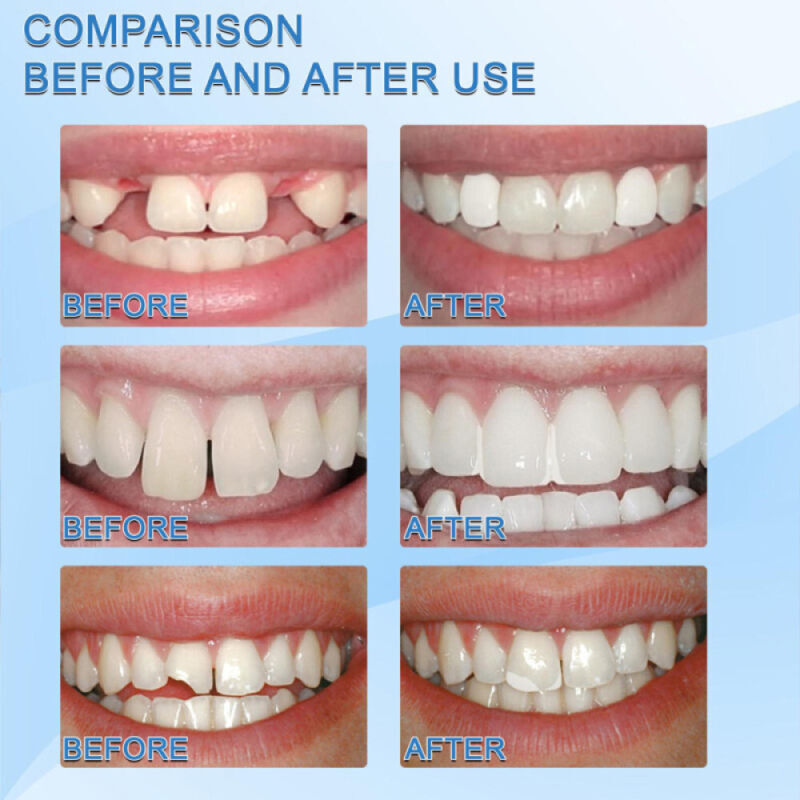 Tooth Repair Kit - Temporary Teeth Replacement Kit for Missing & Broken Teeth