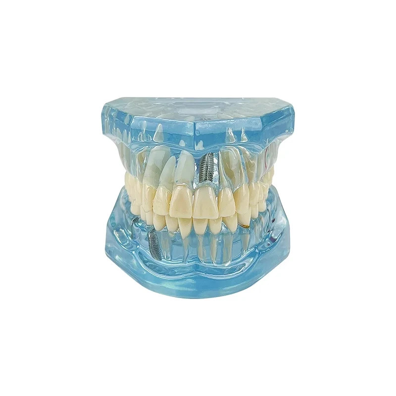 Teeth Repair Model Disease Teeth for Dentist Student Practice Training Studying