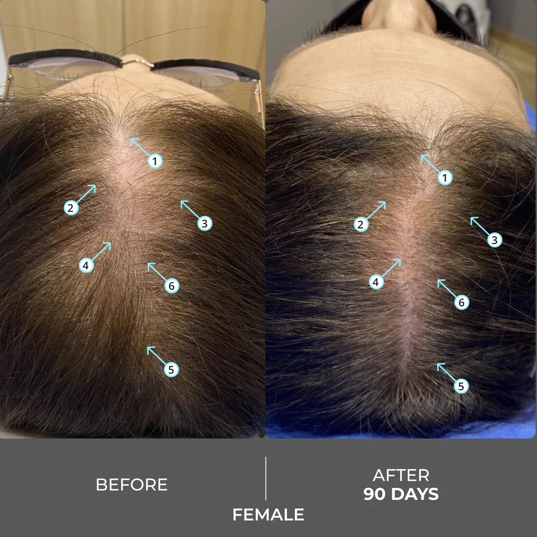 Revita Extra Strength Hair Density Shampoo for Hair Growth for Men and Women