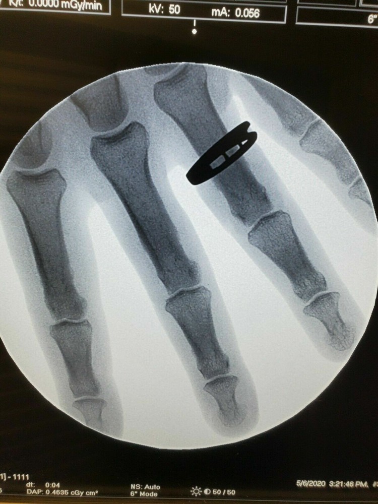 podiatry mini c-arm