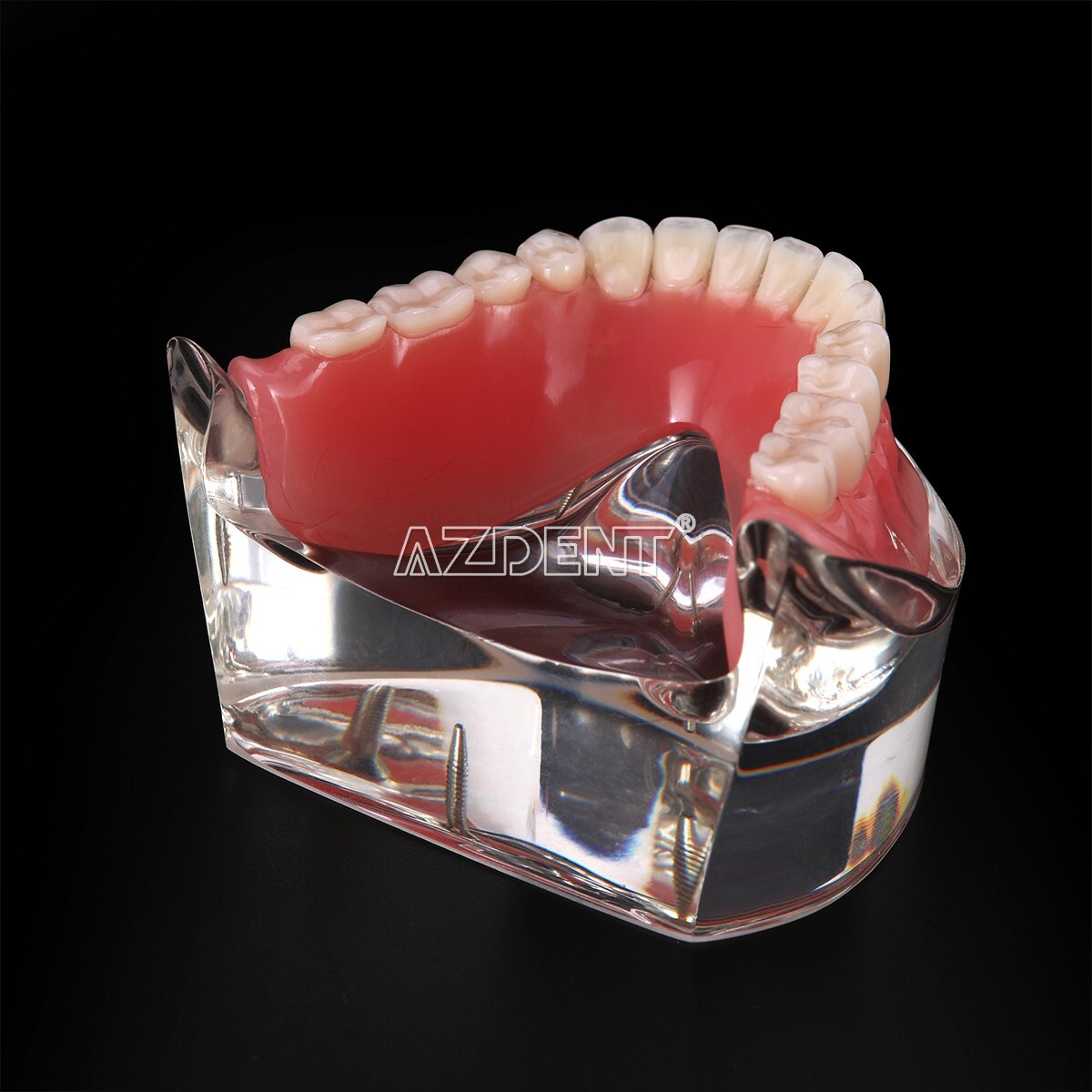 Dental Implant Teeth Model Demo Overdenture Restoration With Implants Lower