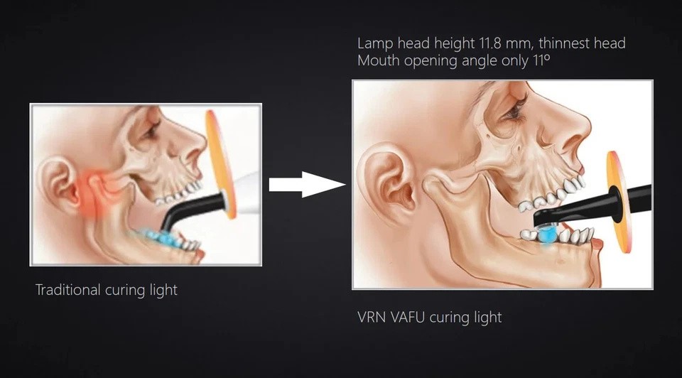 Woodpecker Style Dental iLED Curing Light Lamp Wireless 1Second Curing 3200mw/c㎡