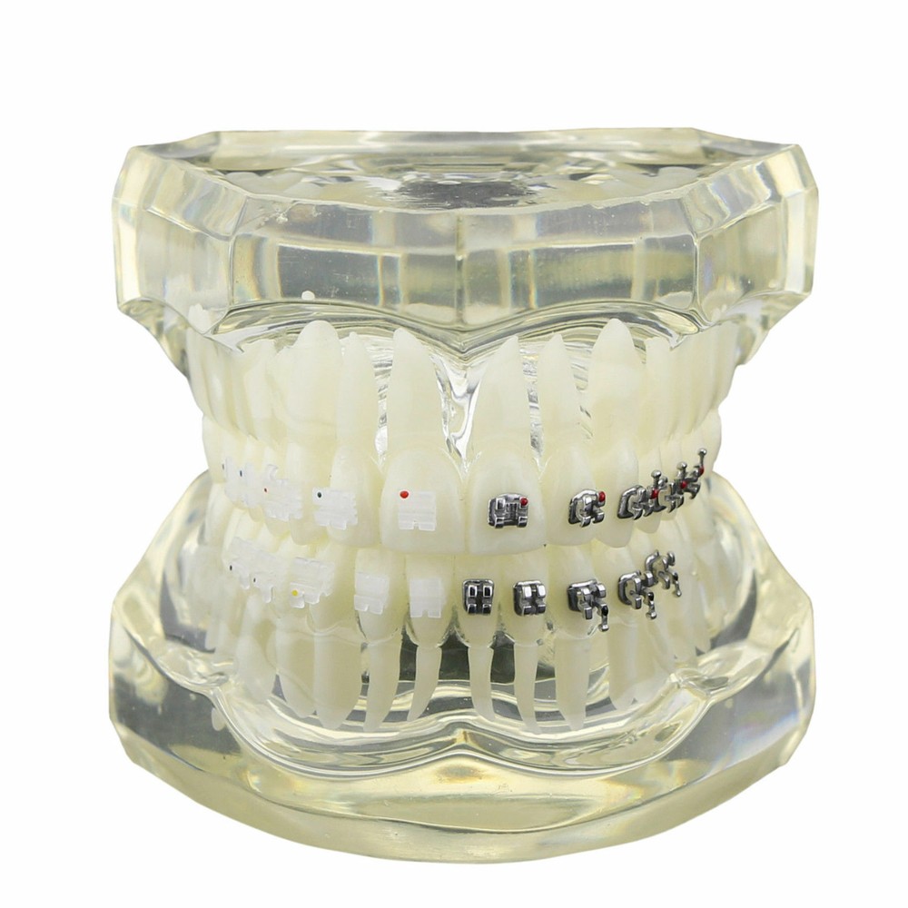 Dental Orthodontic Teeth Study Model with Metal Ceramic Bracket Braces 3003
