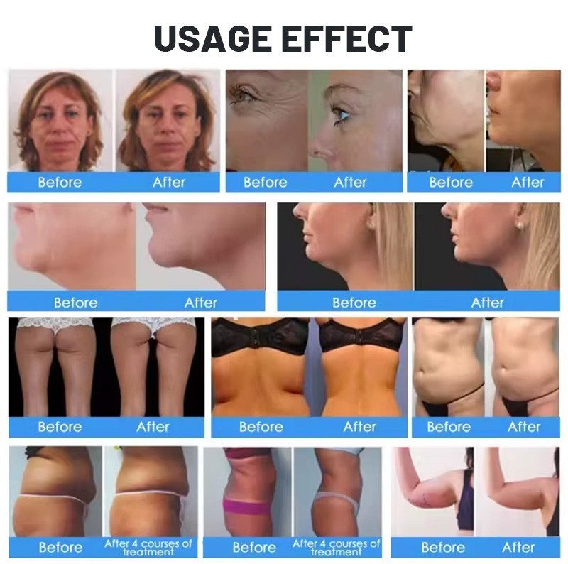 360° Fat Removal Machine