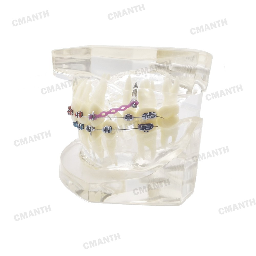 Dental Teeth Model Ceramic Brackets Orthodontic Correction Teaching Model M3005