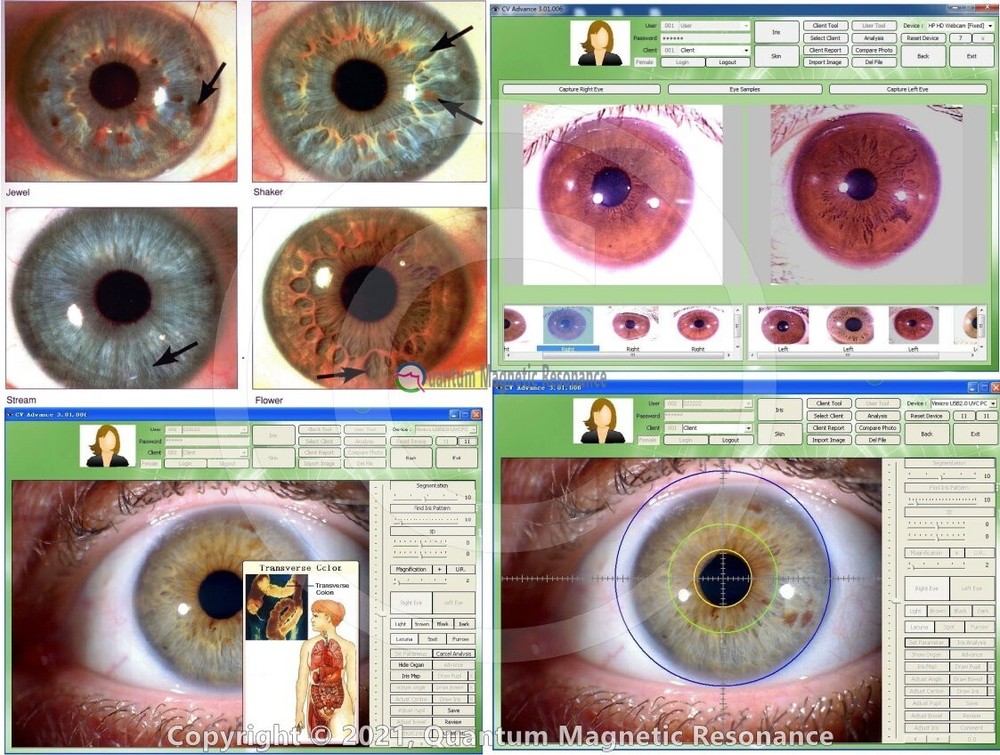 Analyzer Camera HD Iriscope Eye Camera with Analysis Software for Detailed Eye