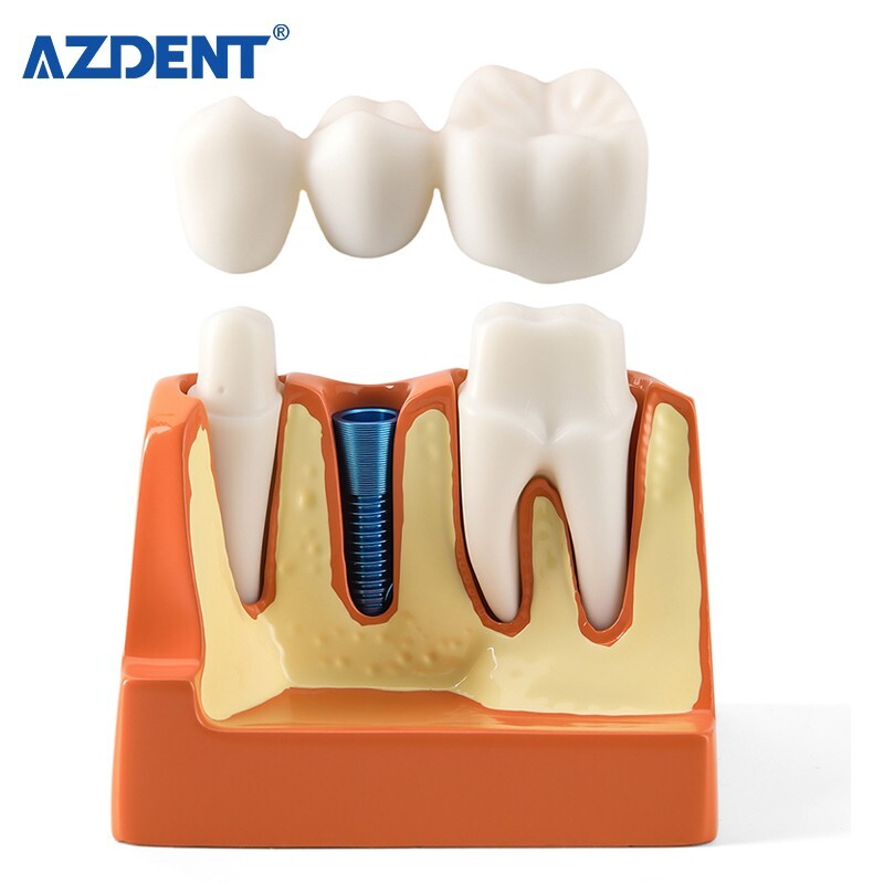 4 Times Dental Teeth Removable Model Implant Teaching Learning Tool Analysis