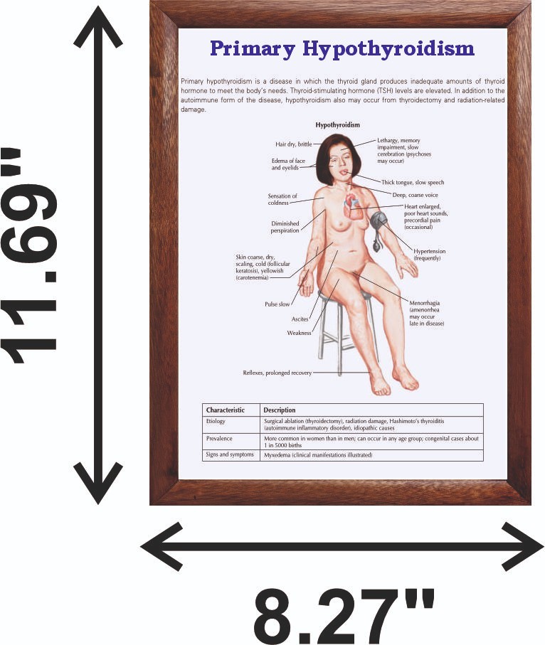 Primary Hypothyroidism Chart 12x18 inches