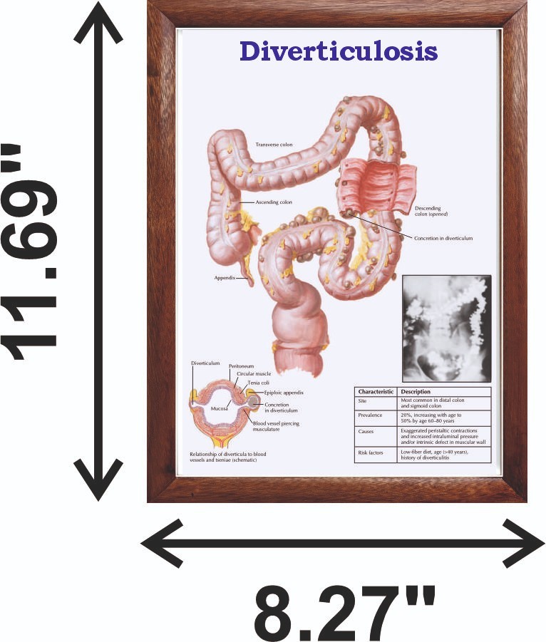 Diverticulosis Chart 12x18 inches