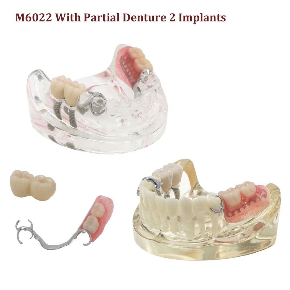Dental Training Typodont Model with Removable Partial Denture Teaching Model