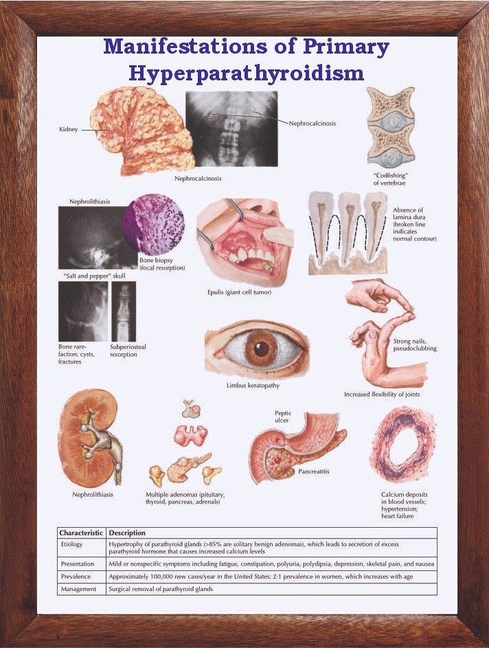 Manifestations of Primary Hyperparathyroidism Chart 12x18 inches