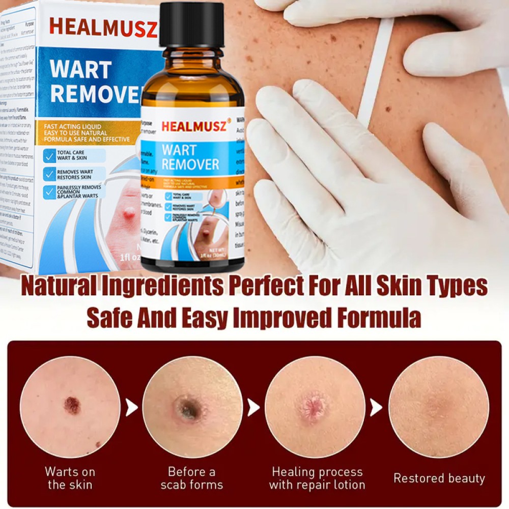 Wart Remover Liquid Skin Tag Mole Remover Eliminate Feet Corn Wart Remove Liquid